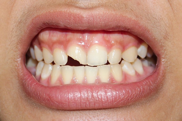 Tips For Preventing Chipped Teeth