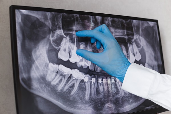Endodontists Treat Complex Tooth Problems Inside Of Teeth