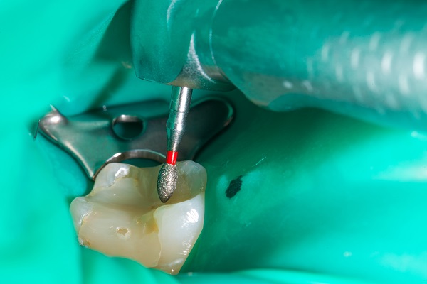 Endodontic Treatment:   Signs A Root Canal Is Necessary