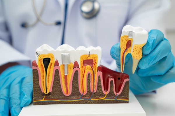 Root Canal Retreatment: What Patients Should Know
