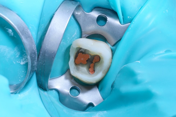 When To Seek Treatment: Signs That You Might Need A Root Canal Specialist