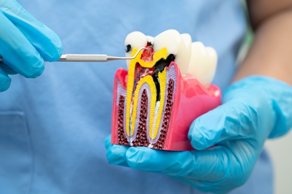 What Is Root Canal Therapy?
